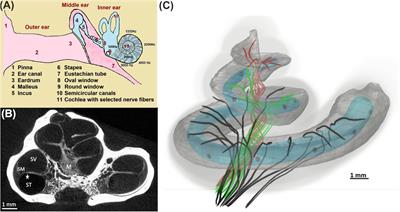 Dendritic Degeneration of Human Auditory Nerve Fibers and Its Impact on the Spiking Pattern Under Regular Conditions and During Cochlear Implant Stimulation
